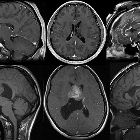 Magnetic Resonance Imaging In Case 1 Showing A Mass Lesion In The Left