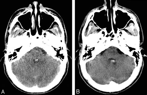 Axial Ct Images At The Level Of The Middle Cerebellar Peduncles Show
