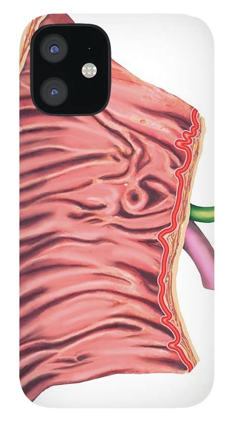 Duodenal Mucosa Relief Iphone 12 Case By Asklepios Medical Atlas Pixels