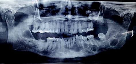 Multiple Odontogenic Keratocyst A Case Report And Review Of Literature