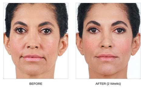 Learn about how much it costs, how long it lasts, what the risks are, and more. Juvederm | Masterpiece Smiles