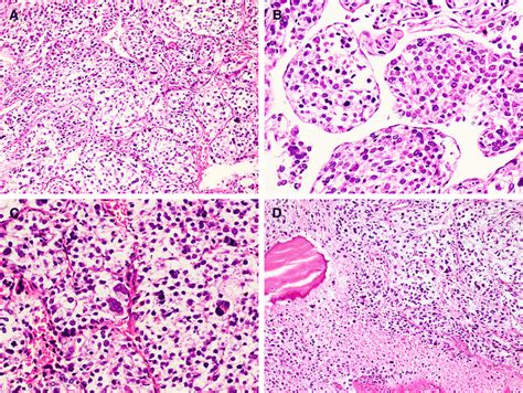 Histology Epithelioid Cells Arranged In Nested Pattern With Delicate