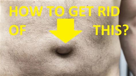 How To Get Rid Of Hernia In Belly Button Youtube