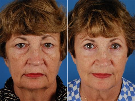 Upper Eyelid Blepharoplasty Before After Photos Patient Langley My XXX Hot Girl
