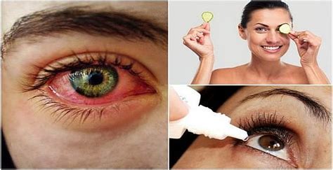 el síndrome del ojo seco qué es y cómo combatirlo de forma natural tu salud es vida