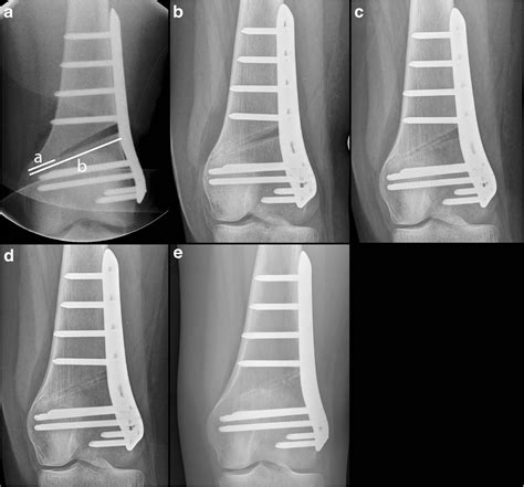 Distal Femoral Varus Osteotomy Results Of The Lateral Open Wedge