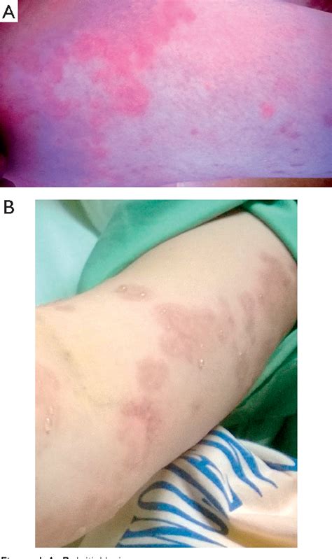 Figure 1 From Pemphigoid Gestationis A Rare Dermatosis Of The