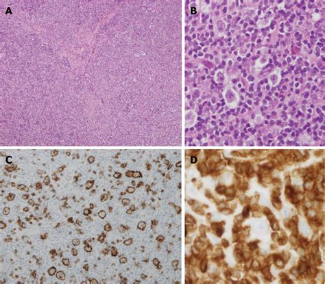 Figure 1 From T Cellhistiocyte Rich Large B Cell Lymphoma In A Child