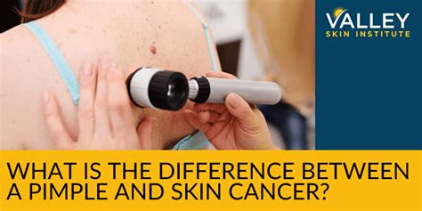 How To Tell The Difference Between A Pimple And Skin Cancer