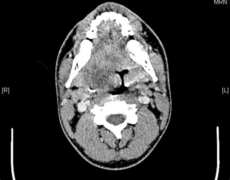 Benign Schwannoma Of The Tonsil Bmj Case Reports