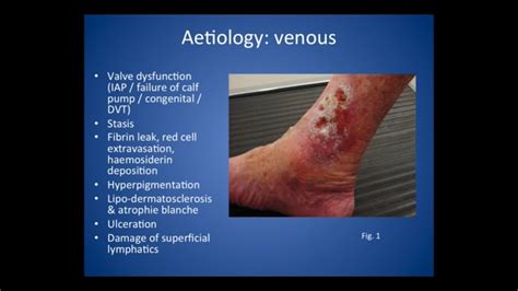 Management Of Venous Ulcer Part 1 Youtube
