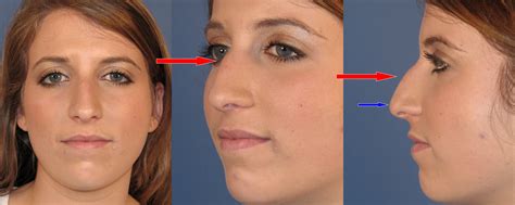 Rhinoplasty For Hump And Poorly Projected Nasal Tip Dr Hilinski