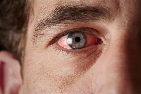 Pink Eye San Jose Conjunctivitis Santa Clara Spectrum Eye Physicians