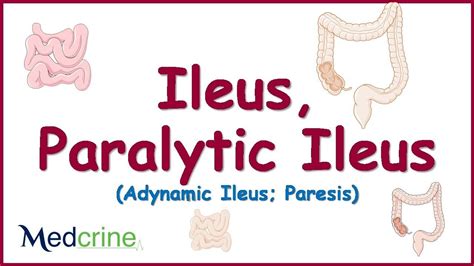 Paralytic Ileus Causes Pathophysiology Clinical Features Diagnosis Diagnosis