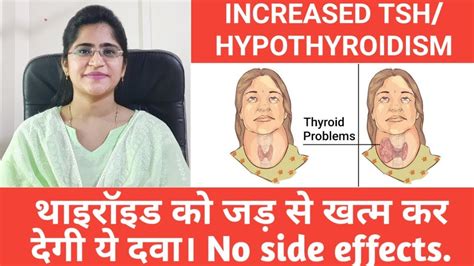 Thyroid Homeopathic Medicine।थाइरॉइड के लिये Homeopathic दवा