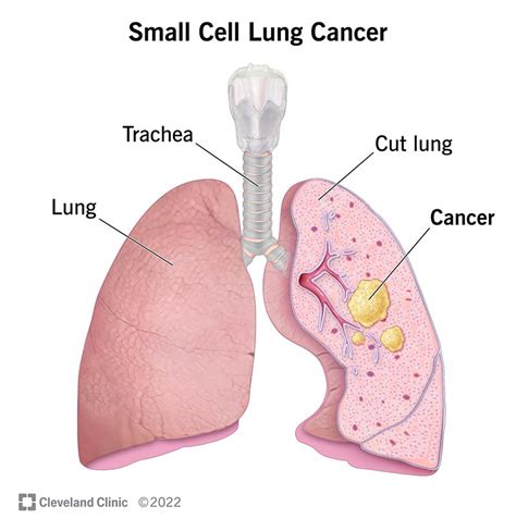 Warning Signs Of Lung Cancer