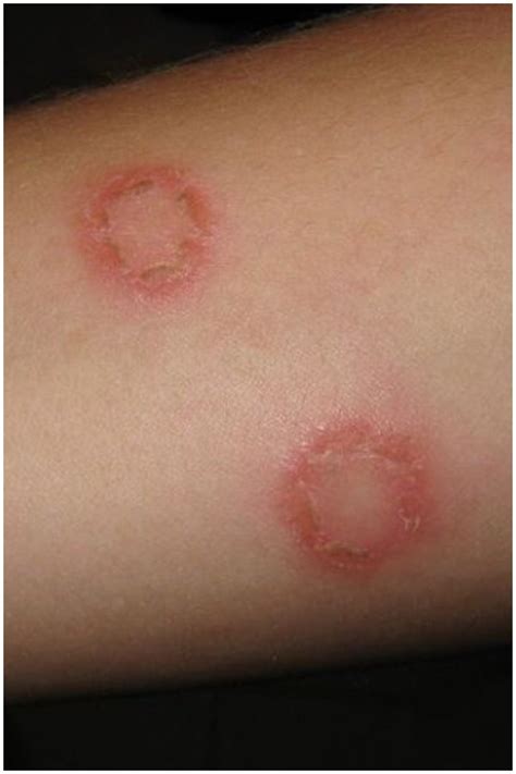 What Causes Ringworm On Your Leg