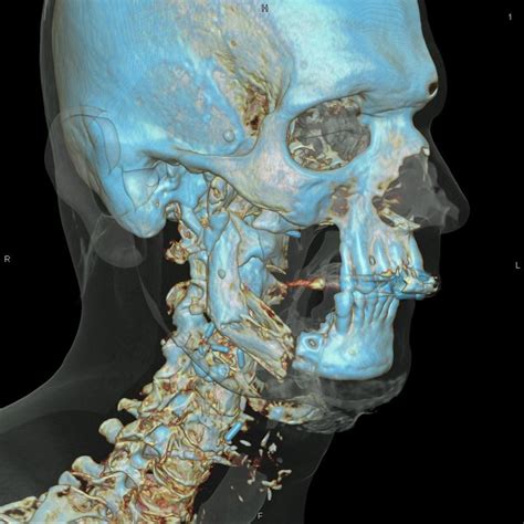 1 Volume Rendering Of A Ct Head Scan Image Courtesy Of Siemens