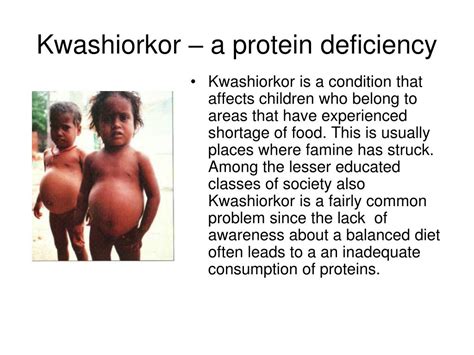Protein Deficiency Kwashiorkor