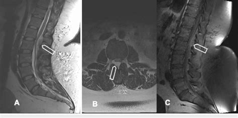 Imaging Findings A Sagittal T2 Weighted Mri Demonstrating The Download Scientific Diagram