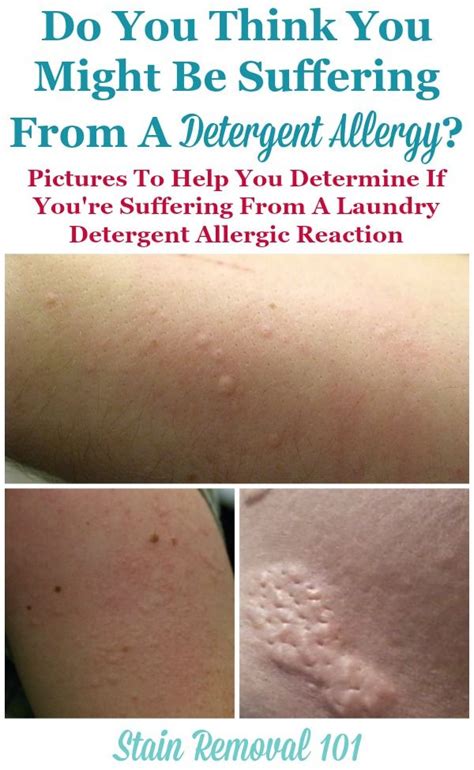 Detergent Allergic Reaction Ph