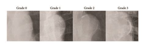 The Aortic Arch Calcification Aac Extent In Four Point Scale And