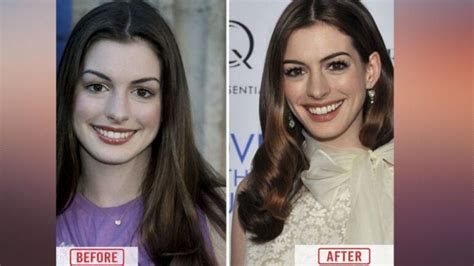 Anne Hathaway Before And After Plastic Surgery Full Transformation