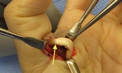 It can be anything but is commonly a TRIGGER THUMB | Hand Surgery Source