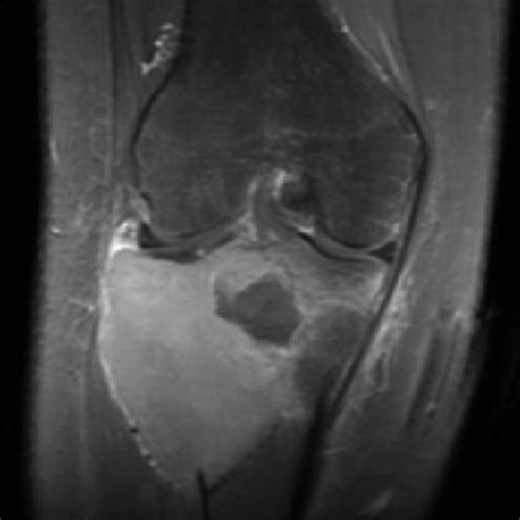 Mri Of Right Knee T2 Weighted Coronal View Shows Heterogenous