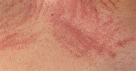 Urticaria And Skin Rashes Signs Causes Treatment Symptoms Images Images