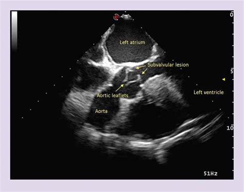 Cutting balloon valvuloplasty for treatment of subaortic stenosis | Vet