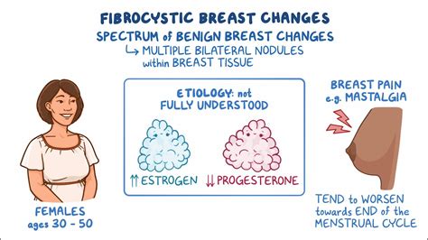 Fibrocystic Breast Changes Clinical Sciences Osmosis Video Library