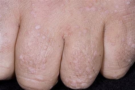 What Causes Warts On Hands Causes And Treatment