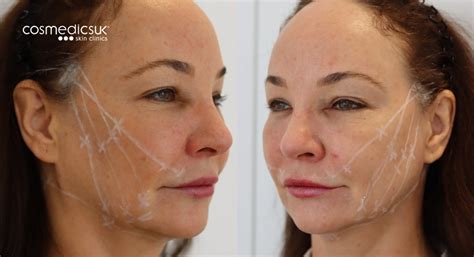 Thread Lift Facelift Treatments Cosmedics Skin Clinics