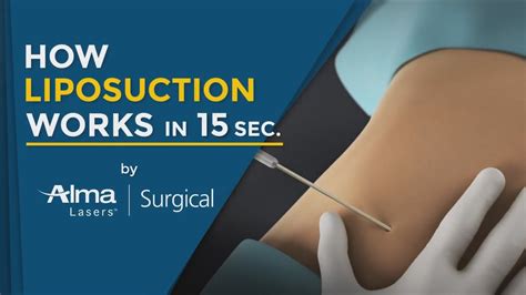 How Liposuction Works In 15 Seconds Medical Technology 3D Animation