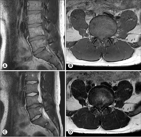 Mri Of The Lumbar Spine Sagittal A And Axial B T1 Weighted Mri Of
