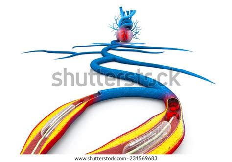 Stent Angioplasty Procedure Placing Balloon Ilustrações Stock