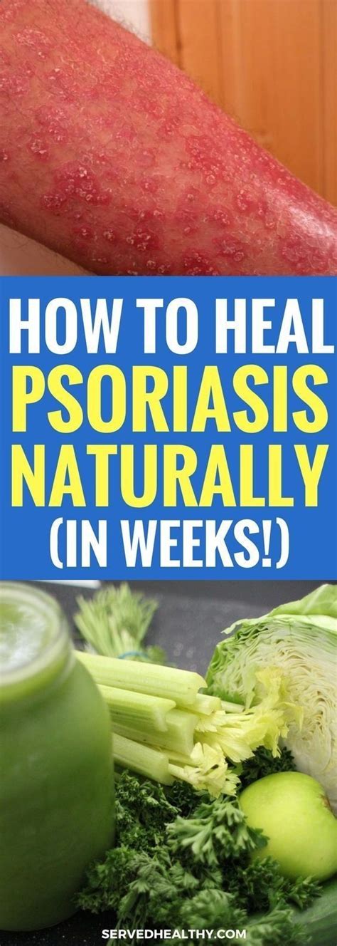 Psoriasis Diet How To Naturally Heal And Clear Psoriasis In Just