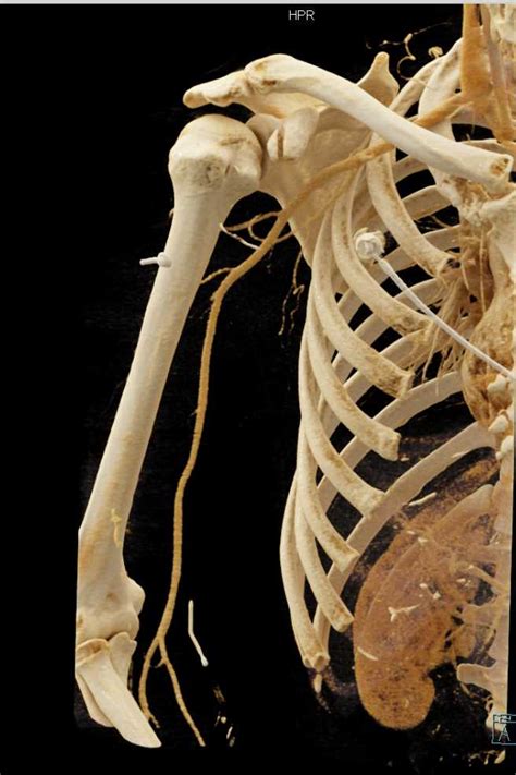 Fracture of Coracoid Process of Scapula with Cinematic ...