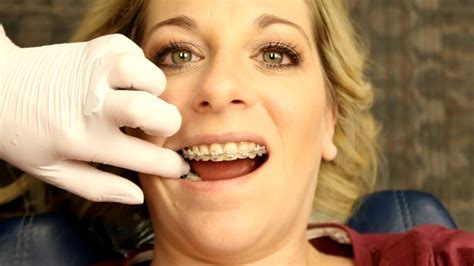 Getting My Braces Off~ Adult Braces Youtube