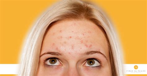 Summer Acne And More Summer Skincare Concerns