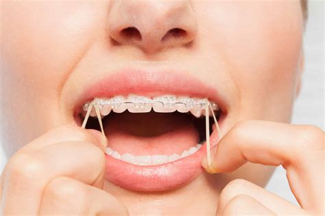 The Importance Of Orthodontic Elastics Dunegan Cole Orthodontics