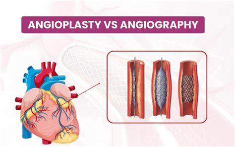 Decoding Angioplasty Vs Angiography 7 Critical Differences Revealed