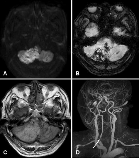 Figure 1 From Medullary Infarction Presenting As Sudden Cardiac Arrest