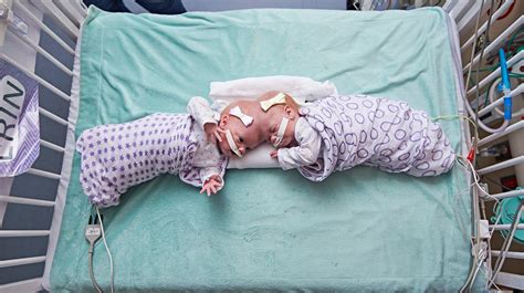 Doctors Just Separated Twin Girls Joined At The Head In One Of The Worlds Rarest Surgeries