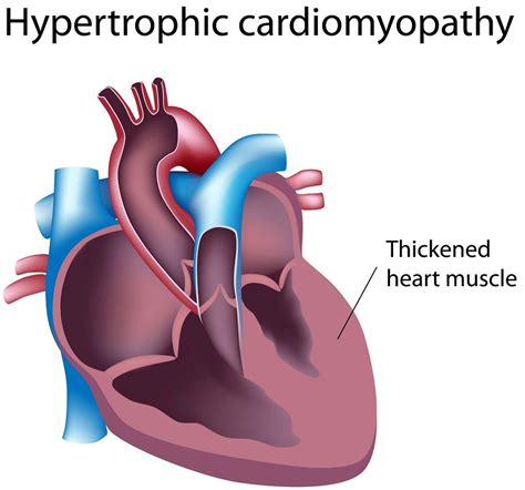 Hypertrophic Cardiomyopathy Causes Symptoms Treatment