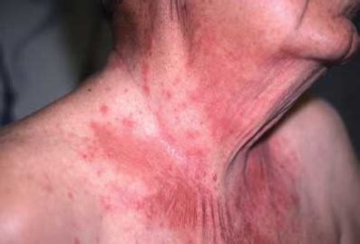 EverythingHealth: Poison Oak