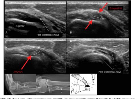 The Utility Of Ultrasound In Showing A Unique Cause Of Posterior