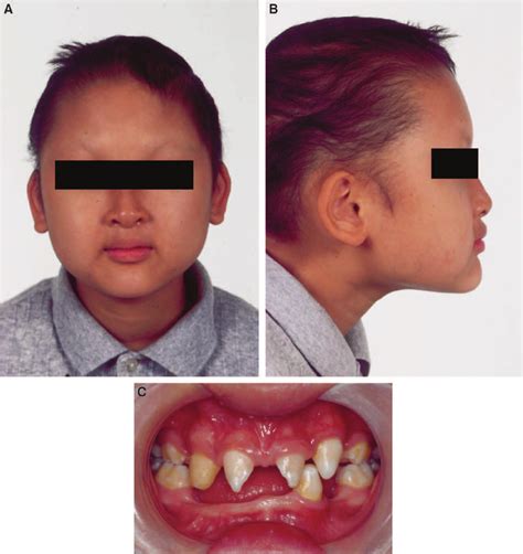 A And B Extraoral Facial Photographs Of Patient Prior To Treatment C