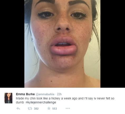 Kylie Jenner Challenge Bruise Famous Person